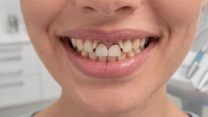 Dinți încălecați: cauze, opțiuni și când începi tratamentul - Main Image