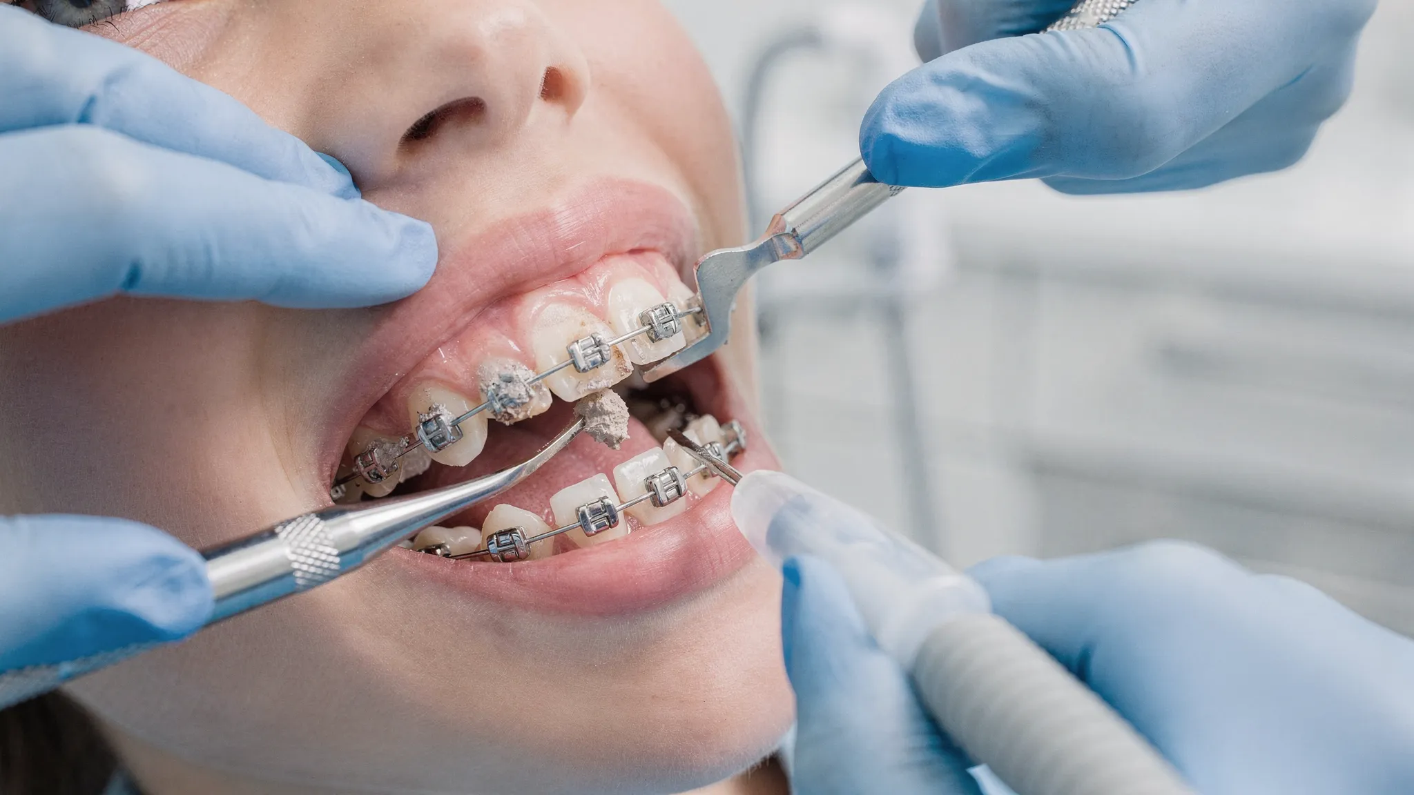 Igienizare profesională la un pacient cu aparat dentar fix, în cabinet stomatologic, cu focus pe îndepărtarea tartrului din jurul brackeților și pe linia gingiei, instrumentar de profilaxie vizibil.