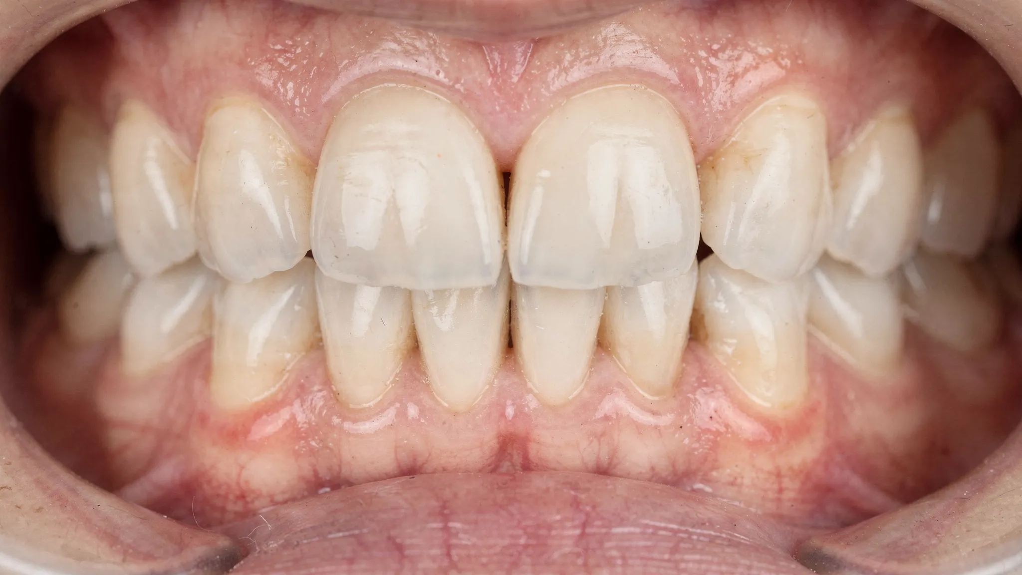Prim-plan al unei arcade dentare cu dinți înghesuiți și suprapuși, evidențiind zonele greu de igienizat dintre incisivi și canini.