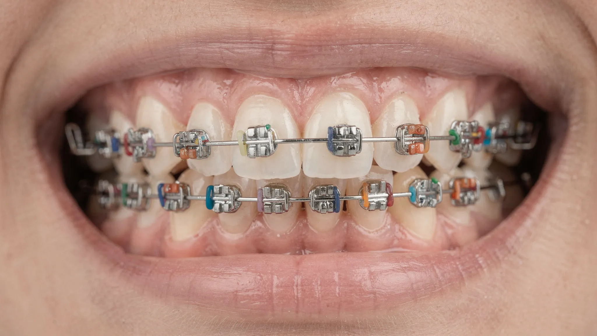 Prim-plan cu un aparat dentar fix pe dinți, evidențiind bracketurile, arcul ortodontic și elasticele de ligatură, într-o imagine clinică clară.