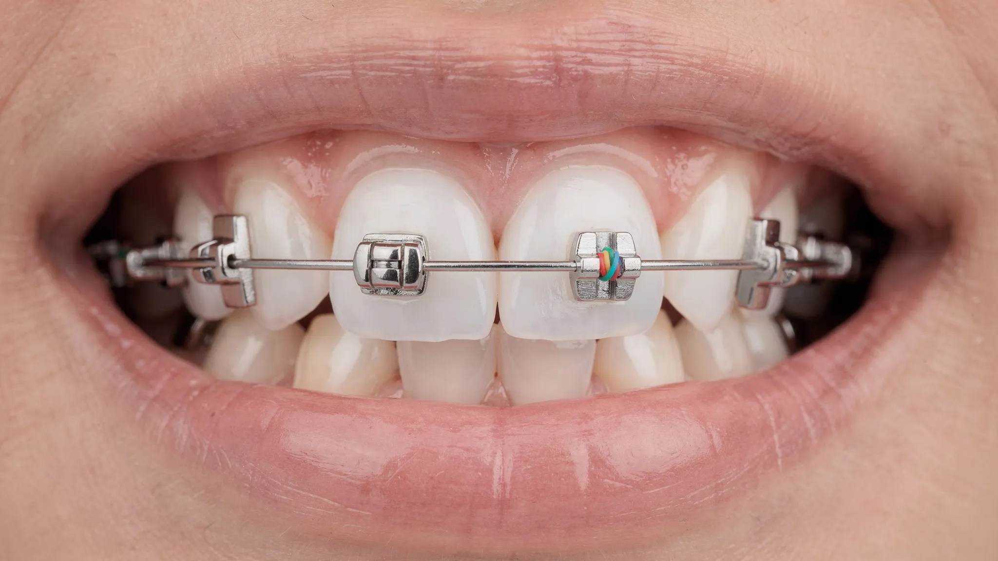 Comparație vizuală între un bracket autoligaturant (cu clip) și un bracket clasic (cu ligatură elastică), văzute de aproape pe dinți.