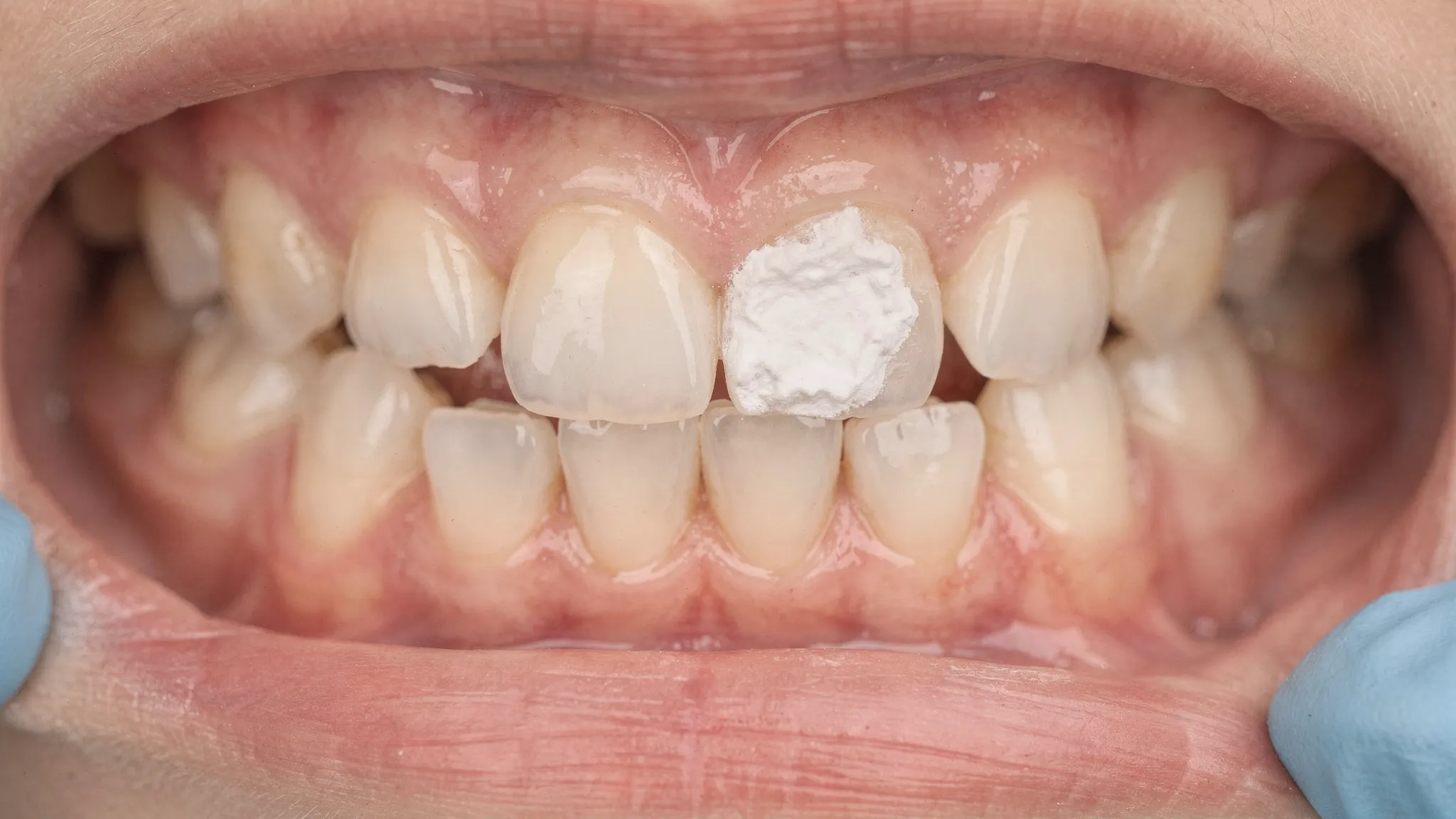 Prim-plan cu incisivi de lapte, unde se observă o zonă albă, mată, cretoasă lângă marginea gingivală, ilustrând aspectul tipic de demineralizare incipientă.