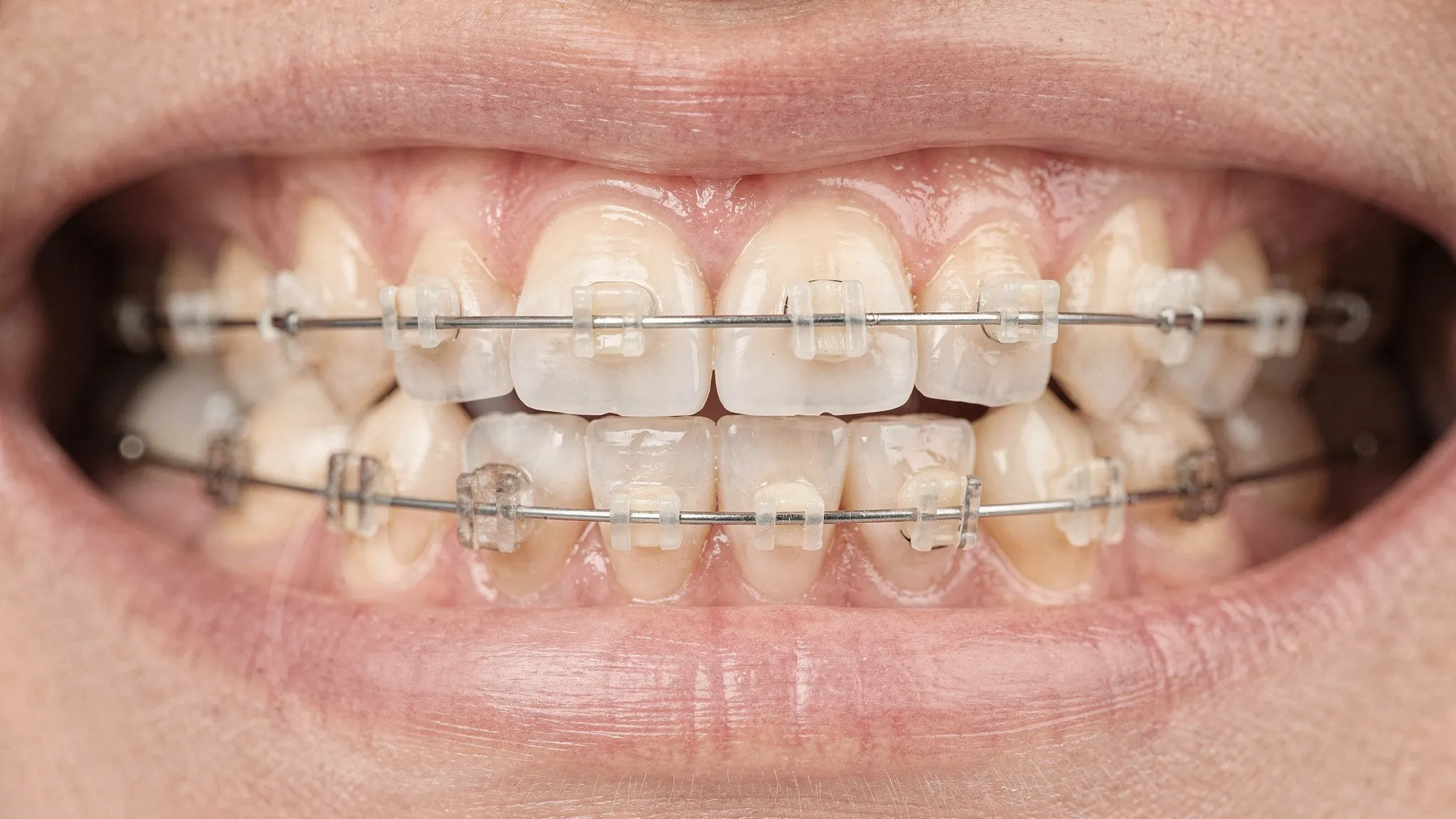 Prim-plan cu un aparat dentar fix ceramic montat pe dinți, bracket-uri de culoarea dintelui și arc ortodontic subțire, aspect discret și estetic.