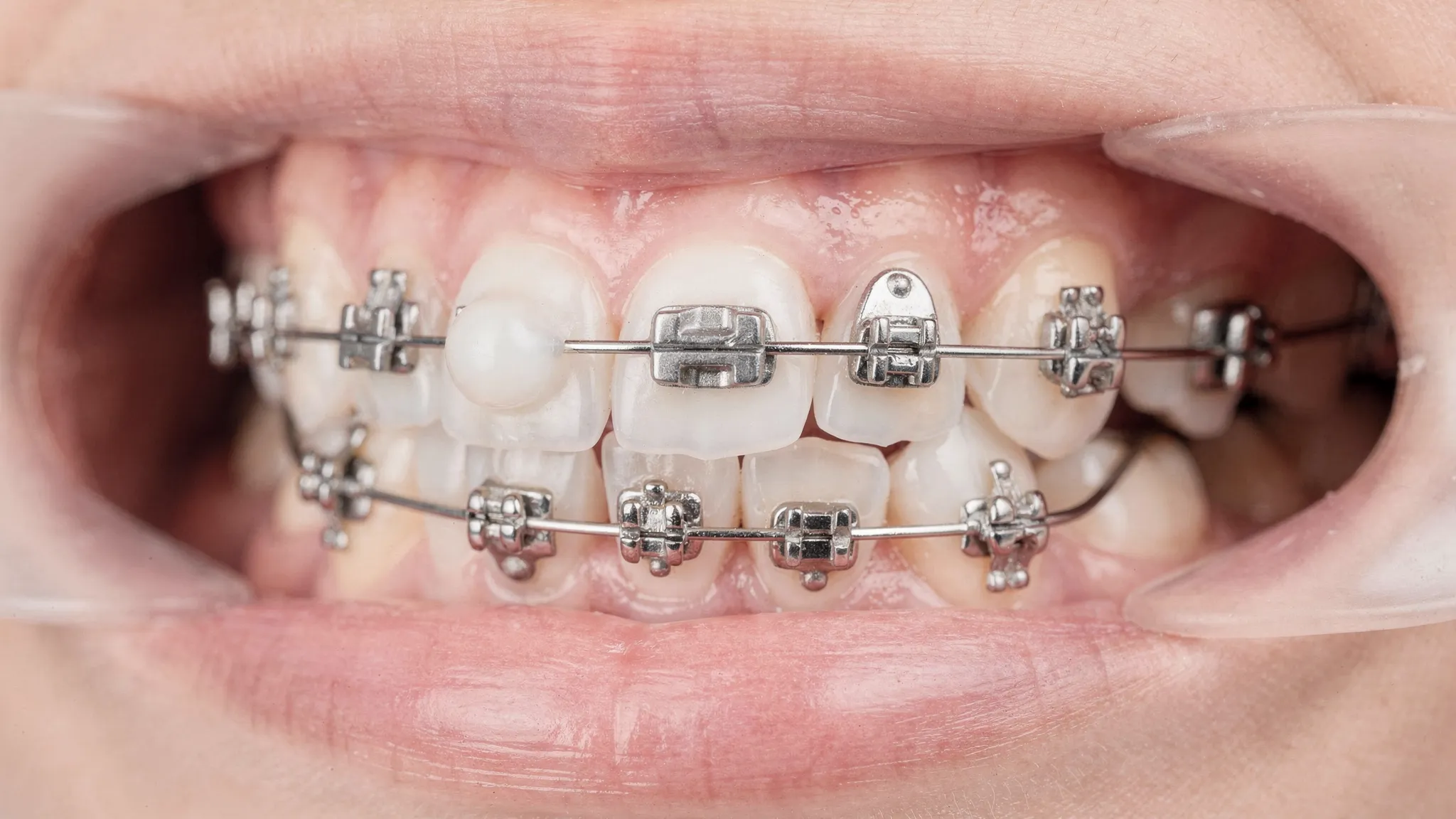 Prim-plan cu un aparat dentar fix pe dinți, evidențiind brackeții și arcul ortodontic, plus aplicarea cerii ortodontice pe un brackeț pentru a reduce iritația.