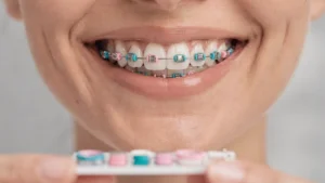 Aparat dentar roz cu turcoaz: cum alegi o combinație reușită - Main Image