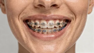 Brackeți dentari: care sunt diferențele între tipuri - Main Image