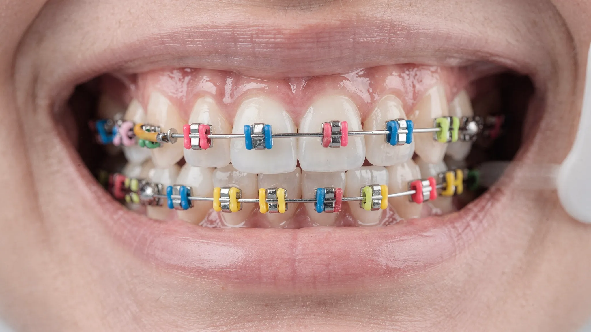 Prim-plan cu un aparat dentar fix pe dinți, cu elastice colorate pe fiecare bracket, iluminare clinică, aspect curat și realist.